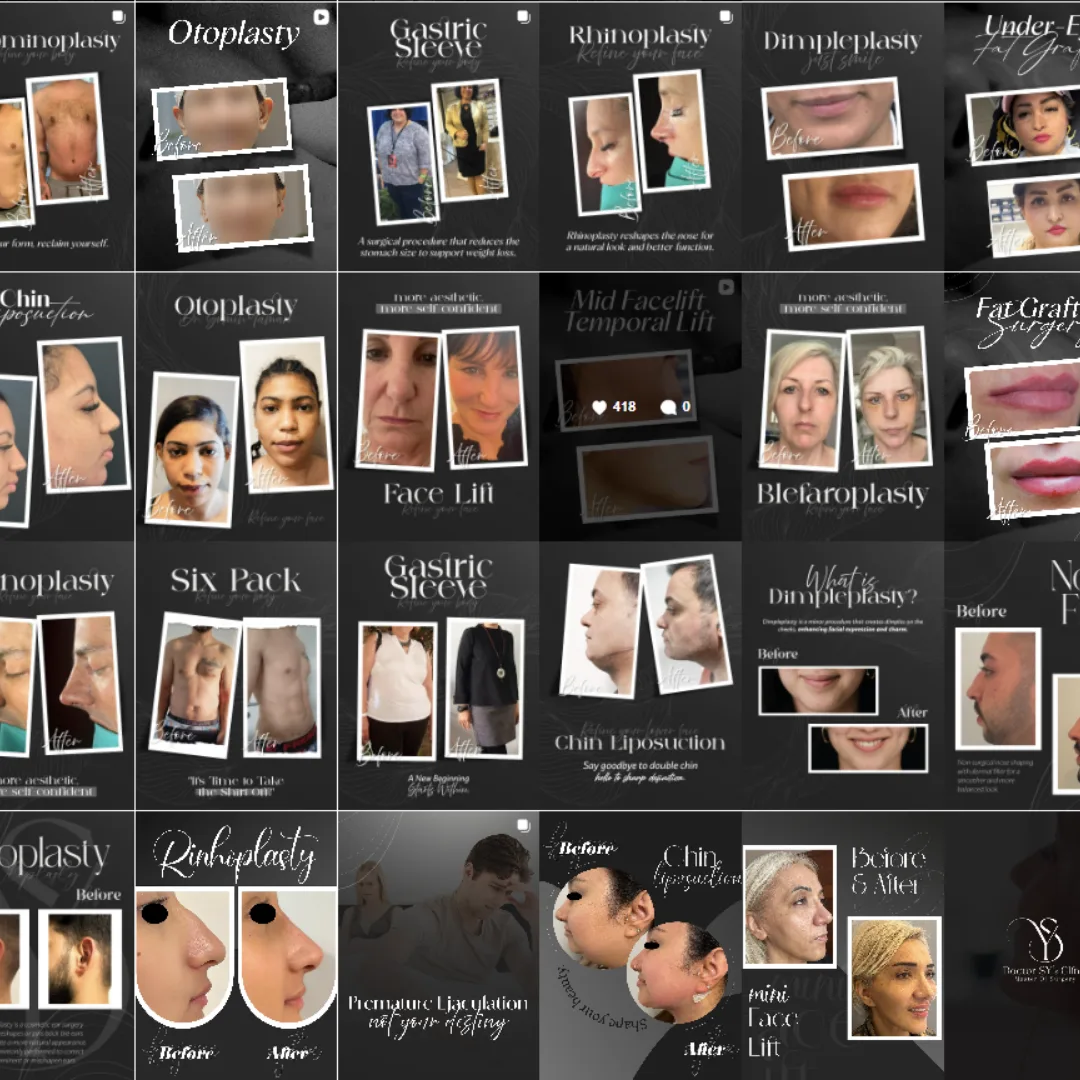 Dr Semih Gokkaya plastic surgery Instagram highlight 5